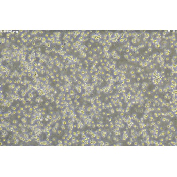 DEL人间变性大细胞淋巴瘤细胞