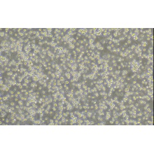 DEL人间变性大细胞淋巴瘤细胞